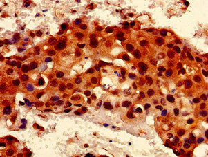 Immunohistochemistry of paraffin-embedded human breast cancer using RALBP1 Antibody at dilution of 1:100Rabbit anti-Human RALBP1 Polyclonal Antibody