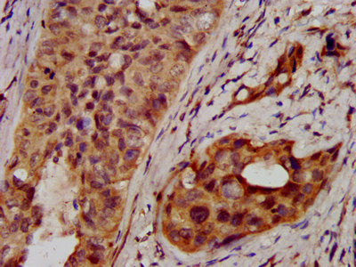 IHC image of NSDHL Antibody diluted at 1:400 and staining in paraffin-embedded human cervical cancer performed on a Leica BondTM system. After dewaxing and hydration, antigen retrieval was mediated by high pressure in a citrate buffer (pH 6.0). Section was blocked with 10% normal goat serum 30min at RT. Then primary antibody (1% BSA) was incubated at 4°C overnight. The primary is detected by a biotinylated secondary antibody and visualized using an HRP conjugated SP system.Rabbit anti-Human NSDHL Polyclonal Antibody