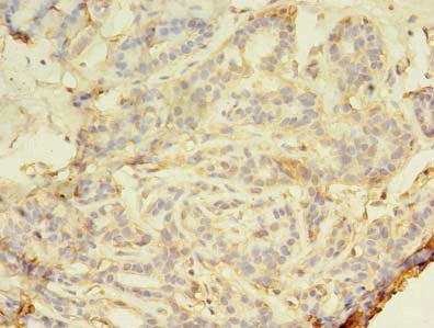 Immunohistochemistry of paraffin-embedded human breast cancer using SMAD1 Antibody at dilution of 1:100Rabbit anti-Human SMAD1 Polyclonal Antibody