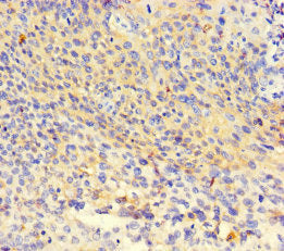 Immunohistochemistry of paraffin-embedded human thyroid tissue using NR1H3 Antibody at dilution of 1:100Rabbit anti-Human NR1H3 Polyclonal Antibody