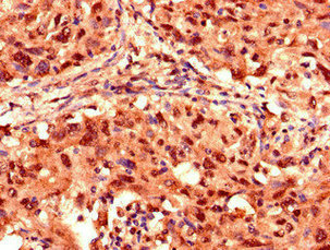 IHC image of PSMD2 Antibody diluted at 1:1000 and staining in paraffin-embedded human lung cancer performed on a Leica BondTM system. After dewaxing and hydration, antigen retrieval was mediated by high pressure in a citrate buffer (pH 6.0). Section was blocked with 10% normal goat serum 30min at RT. Then primary antibody (1% BSA) was incubated at 4°C overnight. The primary is detected by a biotinylated secondary antibody and visualized using an HRP conjugated SP system.Rabbit anti-Human PSMD2 Polyclonal Antibody