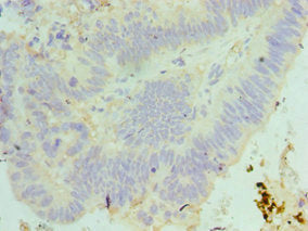 Immunohistochemistry of paraffin-embedded human colon cancer using MAD2L1 Antibody at dilution of 1:100