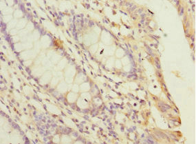 Immunohistochemistry of paraffin-embedded human colon cancer using PPP2R5C Antibody at dilution of 1:100Rabbit anti-Human PPP2R5C Polyclonal Antibody