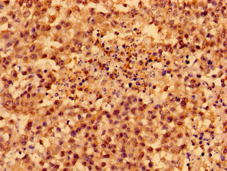 Immunohistochemistry of paraffin-embedded human colon cancer using SMAD4 Antibody at dilution of 1:100Rabbit anti-Human SMAD4 Polyclonal Antibody