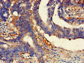 Immunohistochemistry of paraffin-embedded human colon cancer using SCARB2 Antibody at dilution of 1:100Rabbit anti-Human SCARB2 Polyclonal Antibody