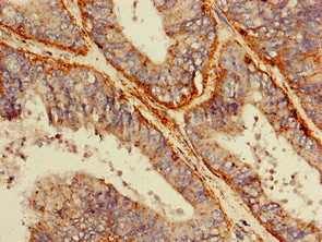 Immunohistochemistry of paraffin-embedded human endometrial cancer using SCARB2 Antibody at dilution of 1:100Rabbit anti-Human SCARB2 Polyclonal Antibody