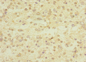 Immunohistochemistry of paraffin-embedded human glioma using UBE4A Antibody at dilution of 1:100