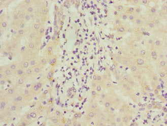 Immunohistochemistry of paraffin-embedded human liver cancer using ICAM4 Antibody at dilution of 1:100Rabbit anti-Human ICAM4 Polyclonal Antibody