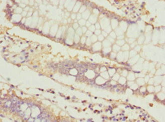 Immunohistochemistry of paraffin-embedded human colon cancer using ICAM4 Antibody at dilution of 1:100Rabbit anti-Human ICAM4 Polyclonal Antibody