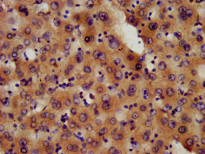 IHC image of the antibody diluted at 1:600 and staining in paraffin-embedded human liver tissue performed on a Leica BondTM system. After dewaxing and hydration, antigen retrieval was mediated by high pressure in a citrate buffer (pH 6.0). Section was blocked with 10% normal goat serum 30min at RT. Then primary antibody (1% BSA) was incubated at 4°C overnight. The primary is detected by a biotinylated secondary antibody and visualized using an HRP conjugated SP system.Rabbit anti-Human PAFAH1B3 Polyclonal Antibody