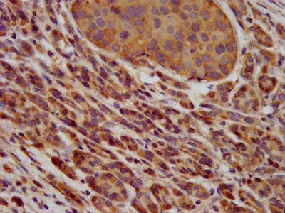 IHC image of PAFAH1B3 Antibody diluted at 1:600 and staining in paraffin-embedded human pancreatic cancer performed on a Leica BondTM system. After dewaxing and hydration, antigen retrieval was mediated by high pressure in a citrate buffer (pH 6.0). Section was blocked with 10% normal goat serum 30min at RT. Then primary antibody (1% BSA) was incubated at 4°C overnight. The primary is detected by a biotinylated secondary antibody and visualized using an HRP conjugated SP system.Rabbit anti-Human PAFAH1B3 Polyclonal Antibody