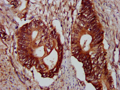 IHC image of the antibody diluted at 1:300 and staining in paraffin-embedded human colon cancer performed on a Leica BondTM system. After dewaxing and hydration, antigen retrieval was mediated by high pressure in a citrate buffer (pH 6.0). Section was blocked with 10% normal goat serum 30min at RT. Then primary antibody (1% BSA) was incubated at 4°C overnight. The primary is detected by a biotinylated secondary antibody and visualized using an HRP conjugated SP system.Rabbit anti-Human PLEC Polyclonal Antibody