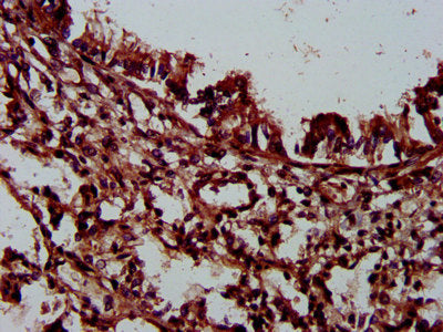 IHC image of PLEC Antibody diluted at 1:300 and staining in paraffin-embedded human lung tissue performed on a Leica BondTM system. After dewaxing and hydration, antigen retrieval was mediated by high pressure in a citrate buffer (pH 6.0). Section was blocked with 10% normal goat serum 30min at RT. Then primary antibody (1% BSA) was incubated at 4°C overnight. The primary is detected by a biotinylated secondary antibody and visualized using an HRP conjugated SP system.Rabbit anti-Human PLEC Polyclonal Antibody