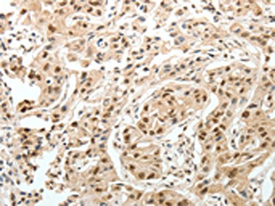 The image on the left is immunohistochemistry of paraffin-embedded Human lung cancer tissue using PSMD3 Antibody(PSMD3 Antibody) at dilution 1/25, on the right is treated with fusion protein. (Original magnification: ×200)