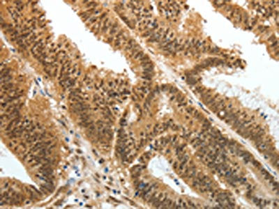 The image on the left is immunohistochemistry of paraffin-embedded Human colon cancer tissue using the antibody Antibody) at dilution 1/25, on the right is treated with fusion protein. (Original magnification: ×200)