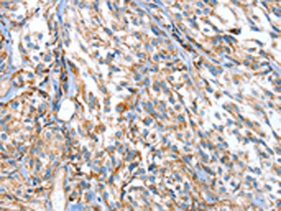 The image on the left is immunohistochemistry of paraffin-embedded Human esophagus cancer tissue using APOBEC3D Antibody(APOBEC3D Antibody) at dilution 1/80, on the right is treated with synthetic peptide. (Original magnification: ×200)Rabbit anti-Human APOBEC3D Polyclonal Antibody