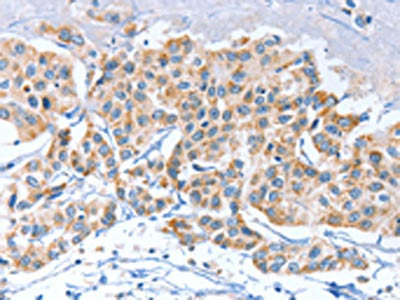 The image on the left is immunohistochemistry of paraffin-embedded Human breast cancer tissue using the antibody Antibody) at dilution 1/80, on the right is treated with synthetic peptide. (Original magnification: ×200)Rabbit anti-Human APOBEC3D Polyclonal Antibody