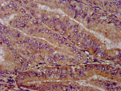 IHC image of PTPA Antibody diluted at 1:1000 and staining in paraffin-embedded human endometrial cancer performed on a Leica BondTM system. After dewaxing and hydration, antigen retrieval was mediated by high pressure in a citrate buffer (pH 6.0). Section was blocked with 10% normal goat serum 30min at RT. Then primary antibody (1% BSA) was incubated at 4°C overnight. The primary is detected by a biotinylated secondary antibody and visualized using an HRP conjugated SP system.Rabbit anti-Human PTPA Polyclonal Antibody