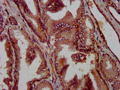 IHC image of PTPA Antibody diluted at 1:1000 and staining in paraffin-embedded human prostate tissue performed on a Leica BondTM system. After dewaxing and hydration, antigen retrieval was mediated by high pressure in a citrate buffer (pH 6.0). Section was blocked with 10% normal goat serum 30min at RT. Then primary antibody (1% BSA) was incubated at 4°C overnight. The primary is detected by a biotinylated secondary antibody and visualized using an HRP conjugated SP system.Rabbit anti-Human PTPA Polyclonal Antibody