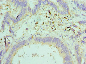 Immunohistochemistry of paraffin-embedded human colon cancer using ELOB Antibody at dilution of 1:100Rabbit anti-Human ELOB Polyclonal Antibody