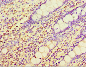 Immunohistochemistry of paraffin-embedded human colon tissue using CHI3L2 Antibody at dilution of 1:100Rabbit anti-Human CHI3L2 Polyclonal Antibody