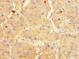 Immunohistochemistry of paraffin-embedded human liver cancer using UGP2 Antibody at dilution of 1:100Rabbit anti-Human UGP2 Polyclonal Antibody