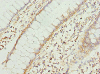 Immunohistochemistry of paraffin-embedded human colon cancer using COX10 Antibody at dilution of 1:100Rabbit anti-Human COX10 Polyclonal Antibody