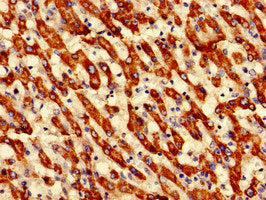 Immunohistochemistry of paraffin-embedded human liver cancer using ECH1 Antibody at dilution of 1:100Rabbit anti-Human ECH1 Polyclonal Antibody
