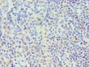 Immunohistochemistry of paraffin-embedded human breast cancer using TARDBP Antibody at dilution of 1:100Rabbit anti-Human TARDBP Polyclonal Antibody