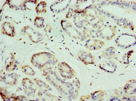 Immunohistochemistry of paraffin-embedded human breast cancer using SLC39A6 Antibody at dilution of 1:100Rabbit anti-Human SLC39A6 Polyclonal Antibody
