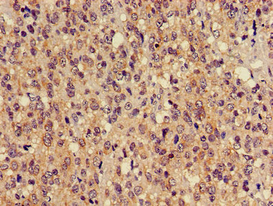 Immunohistochemistry of paraffin-embedded human glioma using TUBA3C Antibody at dilution of 1:100Rabbit anti-Human TUBA3C Polyclonal Antibody