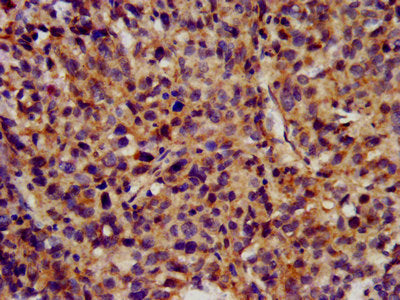 IHC image of the antibody diluted at 1:300 and staining in paraffin-embedded human ovarian cancer performed on a Leica BondTM system. After dewaxing and hydration, antigen retrieval was mediated by high pressure in a citrate buffer (pH 6.0). Section was blocked with 10% normal goat serum 30min at RT. Then primary antibody (1% BSA) was incubated at 4°C overnight. The primary is detected by a biotinylated secondary antibody and visualized using an HRP conjugated SP system.