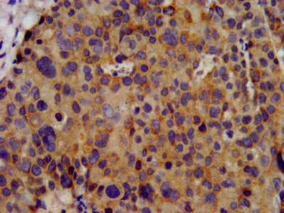 IHC image of KCNC3 Antibody diluted at 1:300 and staining in paraffin-embedded human pancreatic cancer performed on a Leica BondTM system. After dewaxing and hydration, antigen retrieval was mediated by high pressure in a citrate buffer (pH 6.0). Section was blocked with 10% normal goat serum 30min at RT. Then primary antibody (1% BSA) was incubated at 4°C overnight. The primary is detected by a biotinylated secondary antibody and visualized using an HRP conjugated SP system.