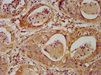 IHC image of the antibody diluted at 1:500 and staining in paraffin-embedded human cervical cancer performed on a Leica BondTM system. After dewaxing and hydration, antigen retrieval was mediated by high pressure in a citrate buffer (pH 6.0). Section was blocked with 10% normal goat serum 30min at RT. Then primary antibody (1% BSA) was incubated at 4°C overnight. The primary is detected by a biotinylated secondary antibody and visualized using an HRP conjugated SP system.Rabbit anti-Human DHX34 Polyclonal Antibody
