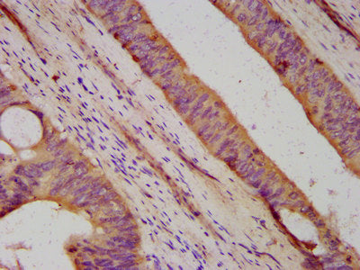 IHC image of DHX34 Antibody diluted at 1:500 and staining in paraffin-embedded human colon cancer performed on a Leica BondTM system. After dewaxing and hydration, antigen retrieval was mediated by high pressure in a citrate buffer (pH 6.0). Section was blocked with 10% normal goat serum 30min at RT. Then primary antibody (1% BSA) was incubated at 4°C overnight. The primary is detected by a biotinylated secondary antibody and visualized using an HRP conjugated SP system.Rabbit anti-Human DHX34 Polyclonal Antibody