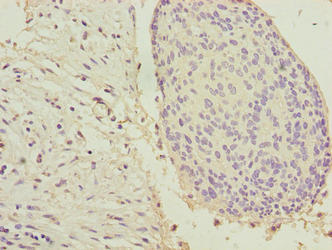 Immunohistochemistry of paraffin-embedded human cervical cancer using KRT33B Antibody at dilution of 1:100