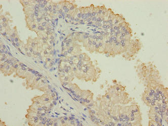 Immunohistochemistry of paraffin-embedded human prostate cancer using KRT33B Antibody at dilution of 1:100