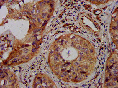 IHC image of LAPTM4A Antibody diluted at 1:300 and staining in paraffin-embedded human cervical cancer performed on a Leica BondTM system. After dewaxing and hydration, antigen retrieval was mediated by high pressure in a citrate buffer (pH 6.0). Section was blocked with 10% normal goat serum 30min at RT. Then primary antibody (1% BSA) was incubated at 4°C overnight. The primary is detected by a biotinylated secondary antibody and visualized using an HRP conjugated SP system.Rabbit anti-Human LAPTM4A Polyclonal Antibody