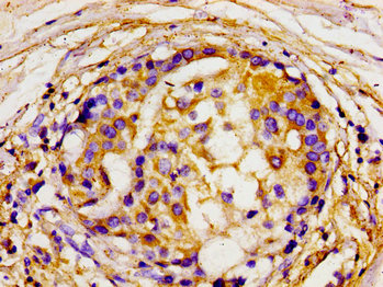 Immunohistochemistry of paraffin-embedded human breast cancer using DLG2 Antibody at dilution of 1:100Rabbit anti-Human DLG2 Polyclonal Antibody
