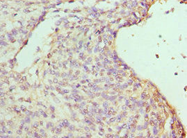 Immunohistochemistry of paraffin-embedded human endometrial cancer using RBBP7 Antibody at dilution of 1:100Rabbit anti-Human RBBP7 Polyclonal Antibody