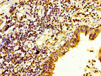 IHC image of the antibody diluted at 1:200 and staining in paraffin-embedded human lung cancer performed on a Leica BondTM system. After dewaxing and hydration, antigen retrieval was mediated by high pressure in a citrate buffer (pH 6.0). Section was blocked with 10% normal goat serum 30min at RT. Then primary antibody (1% BSA) was incubated at 4°C overnight. The primary is detected by a biotinylated secondary antibody and visualized using an HRP conjugated SP system.Rabbit anti-Human DUSP6 Polyclonal Antibody