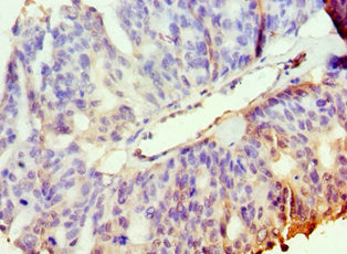 Immunohistochemistry of paraffin-embedded human endometrial cancer using PAK2 Antibody at dilution of 1:100Rabbit anti-Human PAK2 Polyclonal Antibody