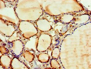 Immunohistochemistry of paraffin-embedded human thyroid tissue using PAK2 Antibody at dilution of 1:100Rabbit anti-Human PAK2 Polyclonal Antibody