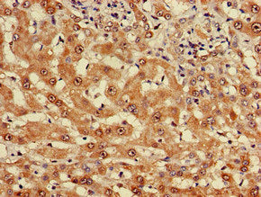 Immunohistochemistry of paraffin-embedded human liver cancer using the antibody at dilution of 1:100Rabbit anti-Human MYO7A Polyclonal Antibody