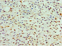Immunohistochemistry of paraffin-embedded human breast cancer using COTL1 Antibody at dilution of 1:100Rabbit anti-Human COTL1 Polyclonal Antibody