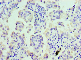 Immunohistochemistry of paraffin-embedded human lung cancer using COTL1 Antibody at dilution of 1:100Rabbit anti-Human COTL1 Polyclonal Antibody