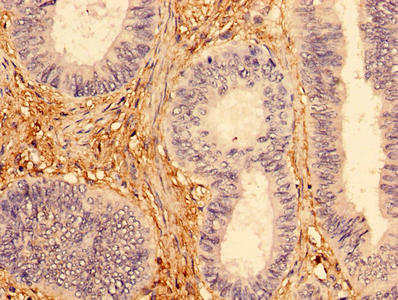 Immunohistochemistry of paraffin-embedded human colon cancer using the antibody at dilution of 1:100