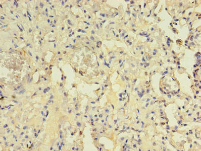 Immunohistochemistry of paraffin-embedded human lung tissue using ACAP1 Antibody at dilution of 1:100Rabbit anti-Human ACAP1 Polyclonal Antibody