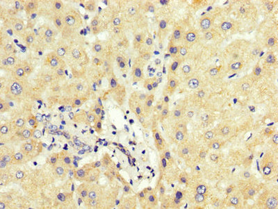 IHC image of PCBP2 Antibody diluted at 1:200 and staining in paraffin-embedded human liver tissue performed on a Leica BondTM system. After dewaxing and hydration, antigen retrieval was mediated by high pressure in a citrate buffer (pH 6.0). Section was blocked with 10% normal goat serum 30min at RT. Then primary antibody (1% BSA) was incubated at 4°C overnight. The primary is detected by a biotinylated secondary antibody and visualized using an HRP conjugated SP system.Rabbit anti-Human PCBP2 Polyclonal Antibody