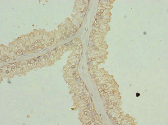 Immunohistochemistry of paraffin-embedded human prostate cancer using GPR68 Antibody at dilution of 1:100Rabbit anti-Human GPR68 Polyclonal Antibody
